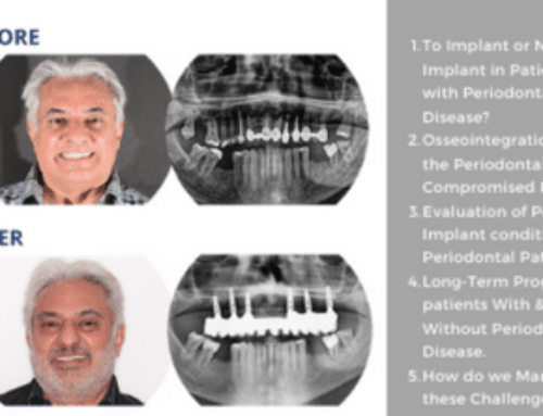 Implant Survival & The Influence of Periodontal Disease